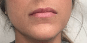 lip-filler